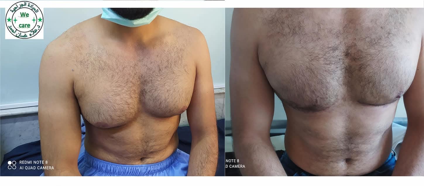 تصحيح التثدّي عند الرجال